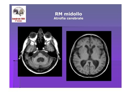 SCLEROSI MULTIPLA E MALATTIE AUTOIMMUNI - Comobrain