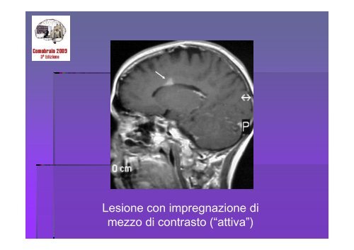 SCLEROSI MULTIPLA E MALATTIE AUTOIMMUNI - Comobrain