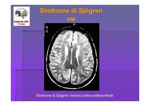 SCLEROSI MULTIPLA E MALATTIE AUTOIMMUNI - Comobrain