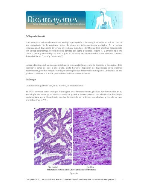 Patología de las Neoplasias del Tubo Digestivo. - Bioarrayanes