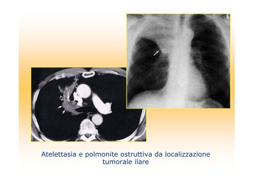 La diagnostica per immagini del polmone e della pleura