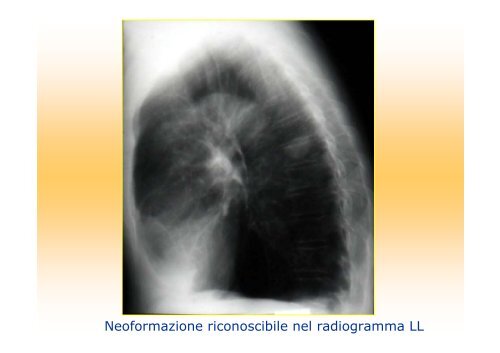 La diagnostica per immagini del polmone e della pleura