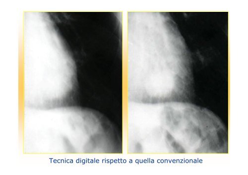 La diagnostica per immagini del polmone e della pleura