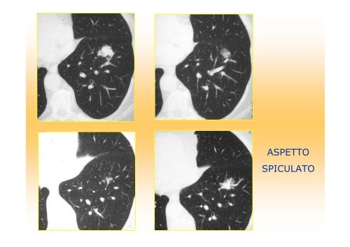 La diagnostica per immagini del polmone e della pleura