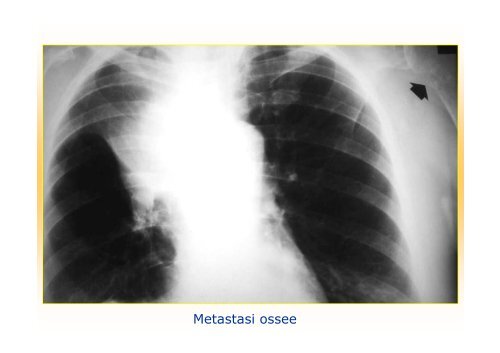 La diagnostica per immagini del polmone e della pleura