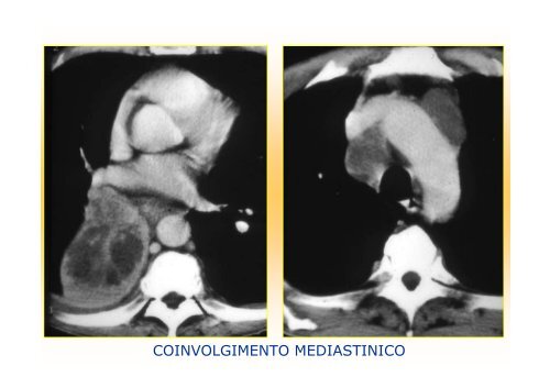 La diagnostica per immagini del polmone e della pleura