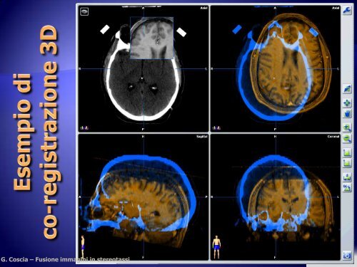 Fusione d'immagini e applicazioni in radioterapia stereotassica