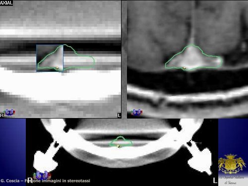 Fusione d'immagini e applicazioni in radioterapia stereotassica