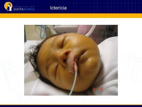 Icterícia neonatal - aefml