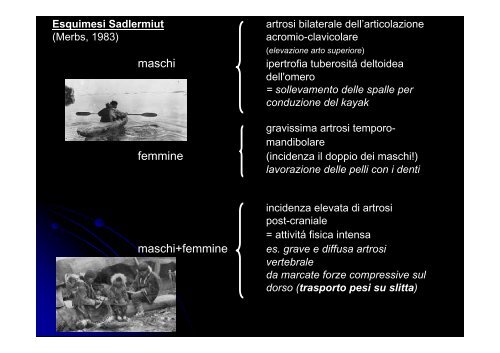 Artrosi vertebrale - Paleopatologia