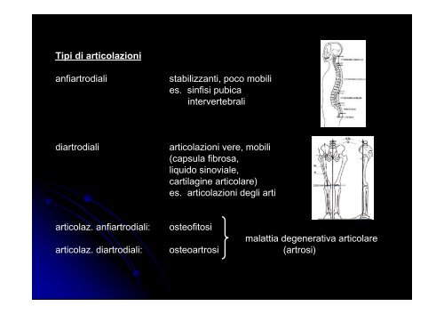 Artrosi vertebrale - Paleopatologia