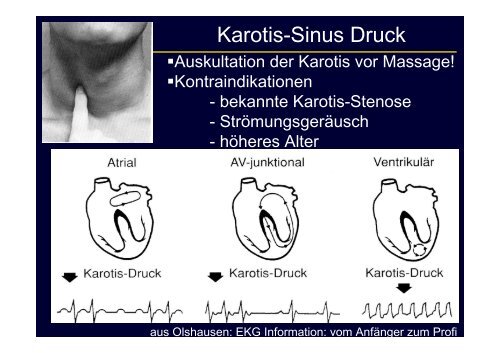 Schmalkomplexige Tachykardie: Differentialdiagnostik und Therapie ...