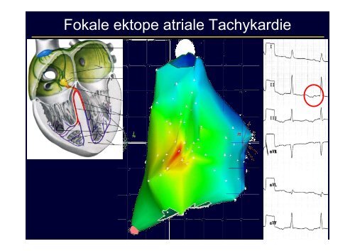 Schmalkomplexige Tachykardie: Differentialdiagnostik und Therapie ...