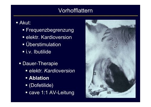 Schmalkomplexige Tachykardie: Differentialdiagnostik und Therapie ...