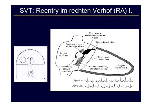 Schmalkomplexige Tachykardie: Differentialdiagnostik und Therapie ...