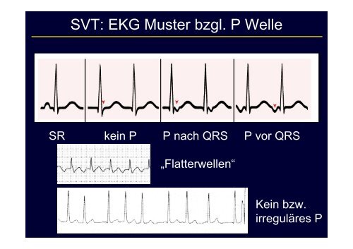 Schmalkomplexige Tachykardie: Differentialdiagnostik und Therapie ...