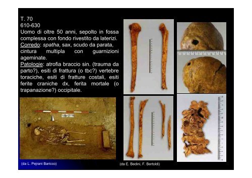 Necropoli longobarda di Collegno,Torino - Paleopatologia