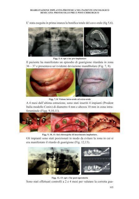 l'implantologia nel paziente con bisogni speciali - Università degli ...