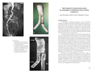 trattamento endovascolare di aneurismi e ... - The Zarins Lab