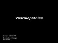 Vasculite leucocytoclasique - epathologies