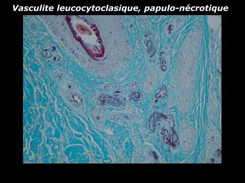 Vasculite leucocytoclasique - epathologies