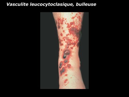 Vasculite leucocytoclasique - epathologies