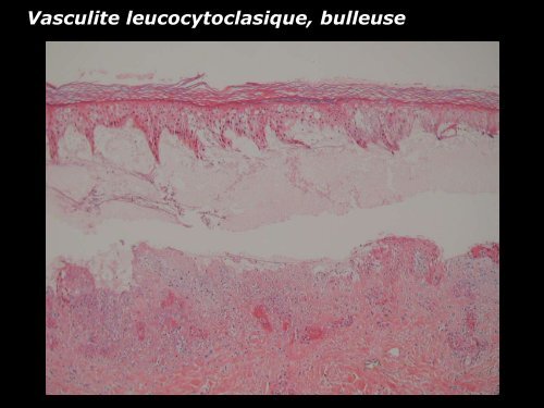 Vasculite leucocytoclasique - epathologies