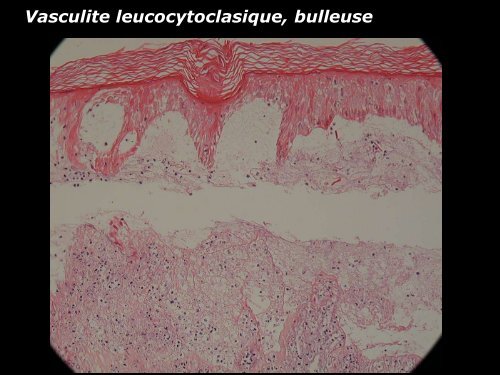 Vasculite leucocytoclasique - epathologies