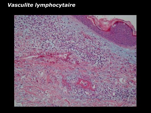 Vasculite leucocytoclasique - epathologies