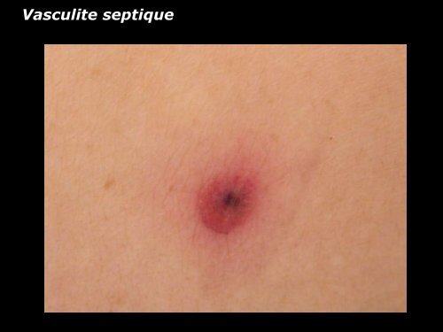 Vasculite leucocytoclasique - epathologies