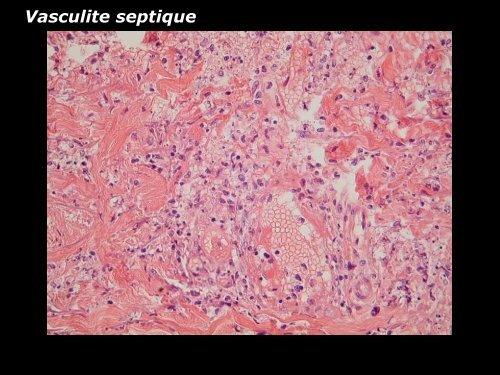 Vasculite leucocytoclasique - epathologies