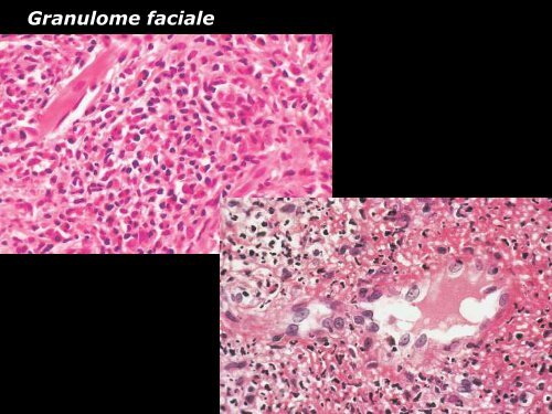 Vasculite leucocytoclasique - epathologies