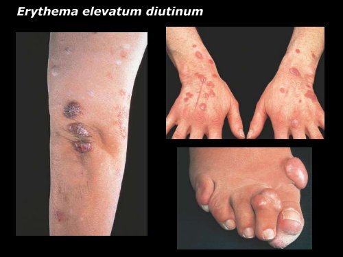 Vasculite leucocytoclasique - epathologies