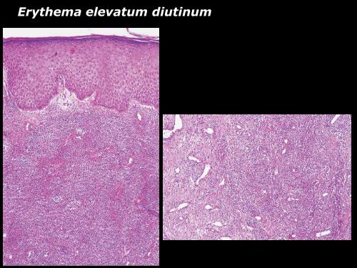 Vasculite leucocytoclasique - epathologies