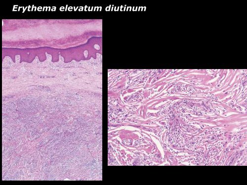 Vasculite leucocytoclasique - epathologies