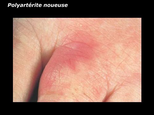 Vasculite leucocytoclasique - epathologies