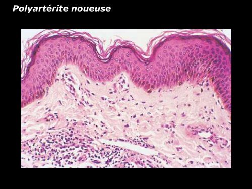 Vasculite leucocytoclasique - epathologies