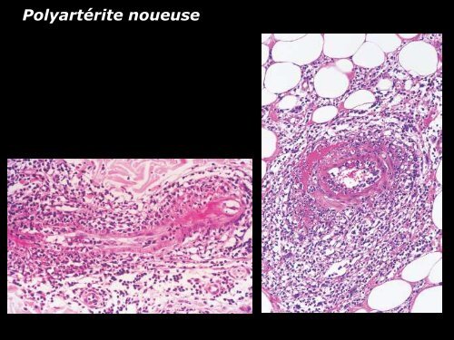 Vasculite leucocytoclasique - epathologies