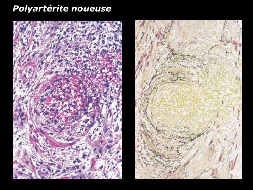 Vasculite leucocytoclasique - epathologies