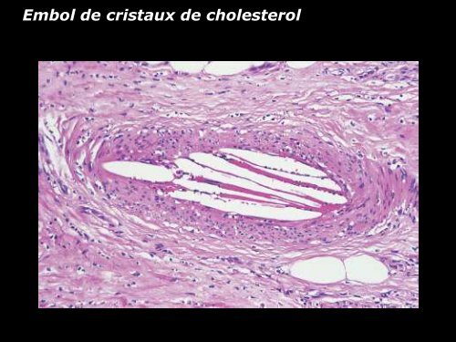 Vasculite leucocytoclasique - epathologies