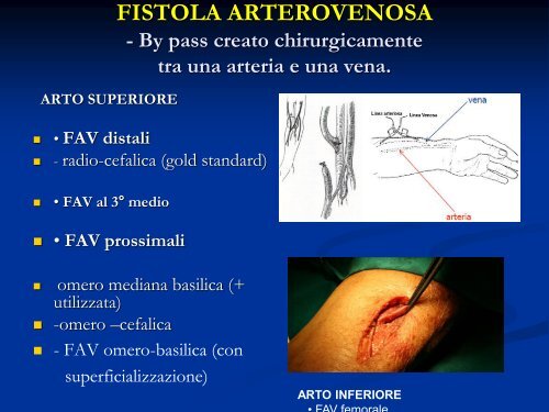 Accessi vascolari per emodialisi - Ipasvioristano.It