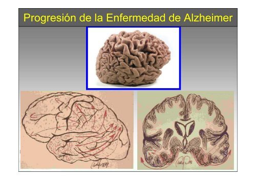 SPECT-PET in neurodegenerative diseases - NUCLEUS