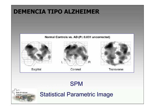 SPECT-PET in neurodegenerative diseases - NUCLEUS