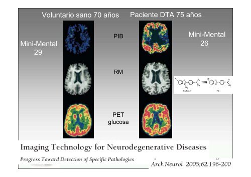 SPECT-PET in neurodegenerative diseases - NUCLEUS