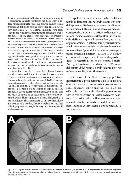 16. Sindromi da alterata pressione endocranica