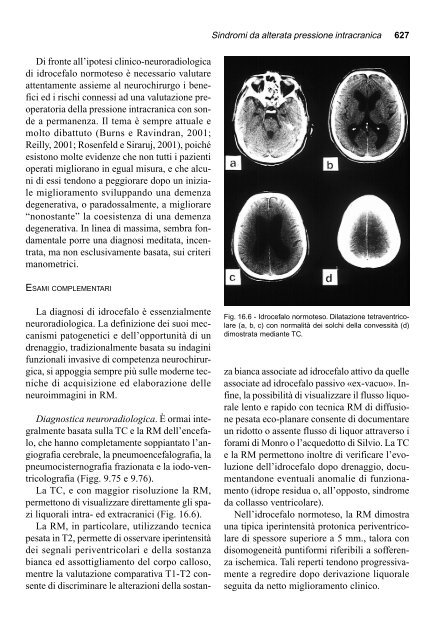 16. Sindromi da alterata pressione endocranica