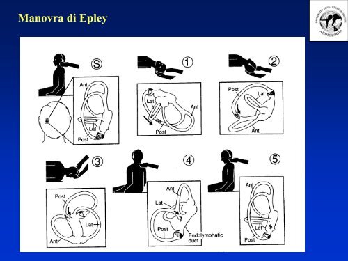 Manovra di Epley - MedWiki