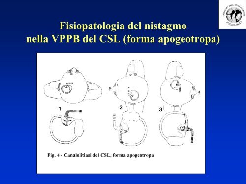 Manovra di Epley - MedWiki