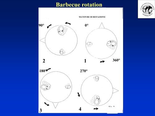 Manovra di Epley - MedWiki