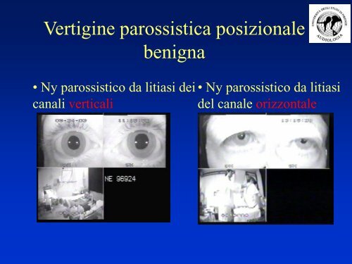 Manovra di Epley - MedWiki